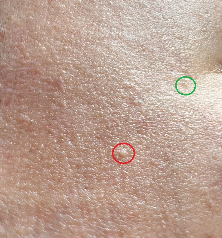 시술한 지 며칠도 안 됐는데 전부 누락 or 재발 됐어요, or 더 퍼졌어요 대표 이미지