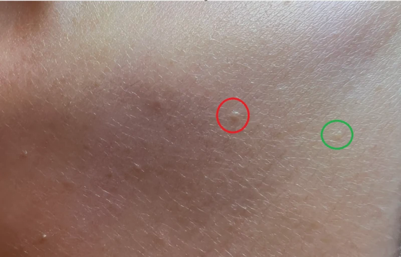 시술한 지 며칠도 안 됐는데 전부 누락 or 재발 됐어요, or 더 퍼졌어요 이미지 3